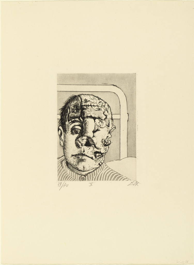 Skin Graft (Transplantation) from The War (Der Krieg)